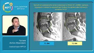 МРТ диагностика дегенеративно-дистрофических заболеваний позвоночника