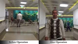 Batdal KURTCU / Before and After Surgery Parkinson's Treatment DBS in Turkey