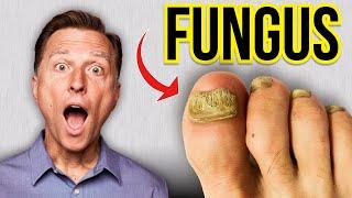 The Fastest Way to Get Rid of Toenail Fungus