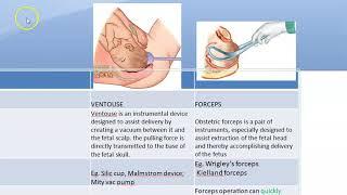 Obstetrics 684 Ventouse vs Forcep Delivery advantage difference vacuum assisted operative instrument