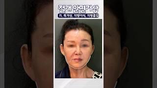 절개 안면거상으로 최소 10년 젊어지기 #안면거상 #목거상 #동안성형