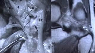 MR of the Knee   Ligaments Anatomy and Patterns of Injury