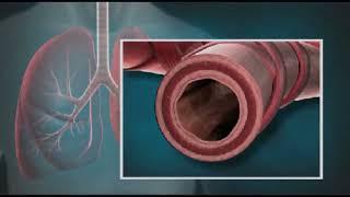 Bronchial Thermoplasty Procedure For Asthma