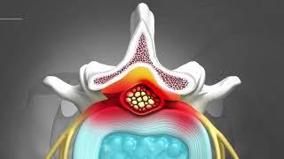 [ENDOVISION SPINE] UBE Spine Endoscopic Surgery 3D Animation