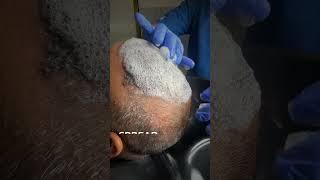 1st Head Wash After 10 Days of Hair Transplant | Post Care