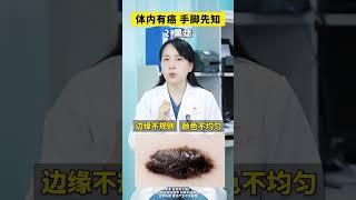 体内有癌，手脚会先告诉你！ #癌症 #痣 #医学科普 #抖出健康知识宝藏 #医疗健康创作训练营