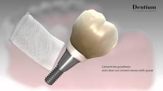 Dentium Prosthesis Procedure