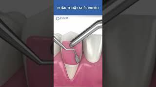 Ghép nướu để làm gì? I Nha Khoa Smile HT #smileht #nhakhoa #ghepnuou