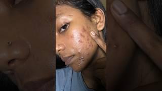 My acne treatment journey #shorts #acnetreatment #skincare #skincareroutine #viral