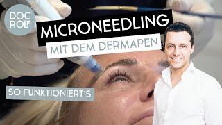 MEDIZINISCHES MICRONEEDLING mit dem DERMAPEN® – Dr. Rolf Bartsch