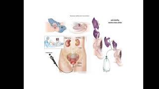 RGU AND MCU PROCEDURE