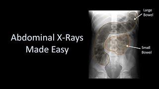 Abdominal X-Rays Made Easy