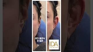 귀 필러로 얼굴이 얼마나 작아져 보일 수 있는지 아시나요?