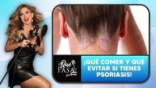 ¡Esta es la dieta que te va a ayudar a controlar la psoriasis! | ¿Qué Pasa? con Mariela