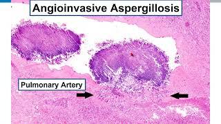 Lung Histopathologic Review: Preparation for Boards Exams AND for Daily Practice