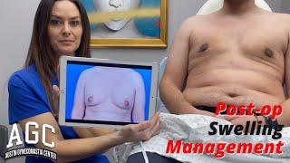 Gynecomastia 3 Weeks Post-Op Swelling Management at the Austin Gynecomastia Center