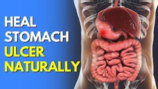 How to Heal a Stomach Ulcer Naturally at Home