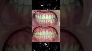 Исправление прикуса До После #допосле #braces #зубы