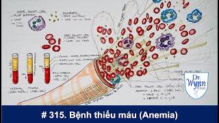 #315. Bệnh thiếu máu (Anemia): nguyên nhân và chữa trị