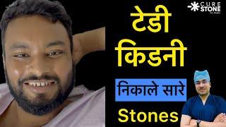 टेडी Kidney Stone Operation | All kidney Stone remove | Laser kidney Stone Treatment | RIRS #kidney