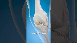 How They Rebuild Torn ACLs 