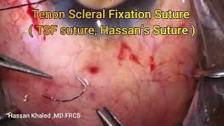 Novel Suture Technique , Hassan's Suture , To close the Tenon during Preserflo Glaucoma surgery