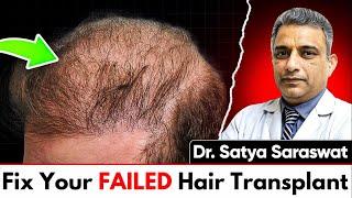 How To Fix A BOTCHED Hair Transplant! – Dr. Satya Saraswat Reveals!