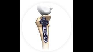 CCWO - Cranial Closing Wedge Osteotomy (CWO, CTWO) Surgical Technique / Technika operacyjna TPLO CWO