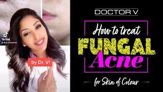 Doctor V - How To Treat Fungal Acne For Skin Of Colour | Brown Or Black Skin | #shorts