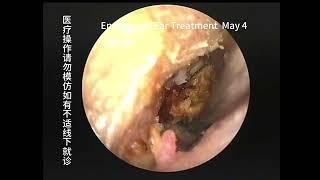 How to deal with cases of cholesteatoma misdiagnosed as cerumen