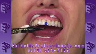 Occlusal Splint Part 1