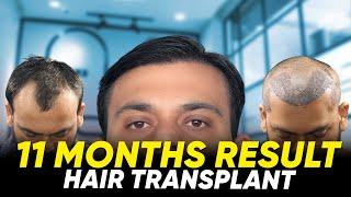 Hair Transplant in Salem | Best Results & Cost of Hair Transplant in Salem