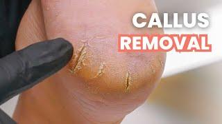 HUGE Heel Cracks + Callus Removal