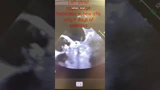 Thrombus in new onset afib on pradaxa