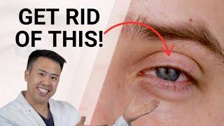 How To Get Rid of Dry Eye in as soon as 2 Weeks