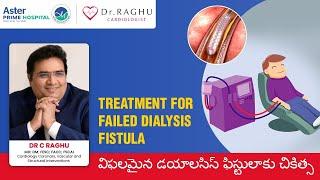 Treatment for failed dialysis fistula | Dialysis | AV Fistula | Dr C Raghu