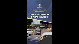 Animation Reveals Plaintiffs Spinal Injuries From Intersection Accident