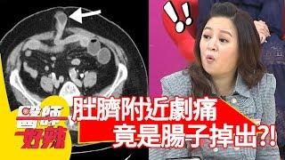 肚臍附近突劇痛？竟是「腸子掉出」險壞死？！【醫師好辣】 20181224 part4 EP662李懿 洪永祥