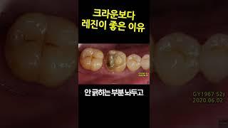 크라운보다 레진이 좋은 이유. 인레이탈락시 레진해도 충분. 인레이,크라운은 치아를 망치는 지름길이므로 레진하는게 가장 안전 DentiTube20230625 [r26]