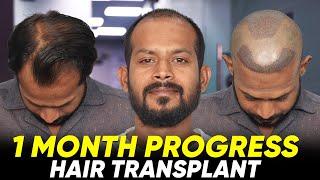 Hair Transplant in Surat | Best Results & Cost of Hair Transplant in Surat