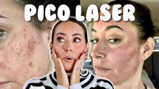 PICO LASER - THE FASTEST WAY TO REMOVE HYPERPIGMENTATION? Everything You Need to Know + Pros & Cons