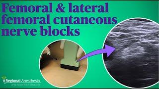 Femoral and lateral femoral cutaneous nerve blocks