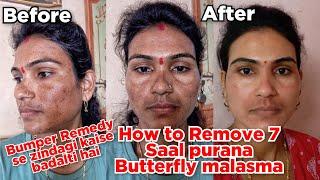 How to Remove 7 Saal Purana Butterfly Malasma | Pigmentation Removing Bumper Remedy