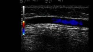 Phlebology Biosound Esaote MyLab 25 Proximal GSV with Reflux