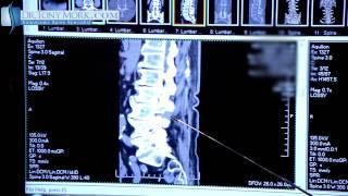 FACET SYNDROME AFTER TRANSFACET DECOMPRESSION BY DR. TONY MORK