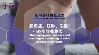 拆解静脉曲张迷思-有脚痛红肿发黑？小心引致蜂巢炎Having leg pain,redness and swelling darkening of skin?Beware of cellulitis!