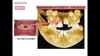 “12歲以前的早期矯正治療-不需要用矯正器或隱適美來排正長歪的牙齒（二）”