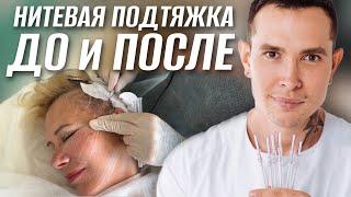 Подтяжка нитями ДО и ПОСЛЕ | Процесс установки нитей #мезонити