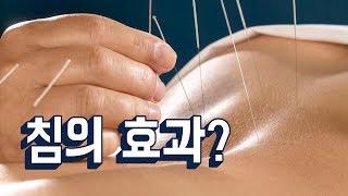 한의학 침은 진짜 효과가 있을까?