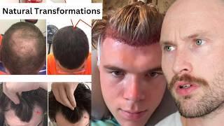 HAIR LOSS INDUSTRY Trends DESTROYING MEN